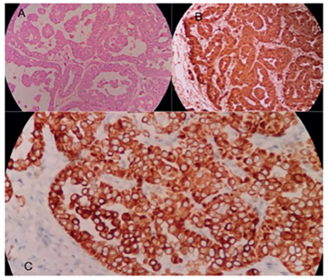 A. Compromiso por c&eacute;lulas mesoteliales at&iacute;picas en grupos que forman trab&eacute;culas e infiltran la grasa con un patr&oacute;n irregular. Hematoxilina y eosina, 10X. B. Las c&eacute;lulas tumorales son positivas para calretitina. Inmunohistoqu&iacute;mica, 10X. C. Tambi&eacute;n, son positivas para las citoqueratinas 5 y 6, la citoqueratina 7, el factor WT1 y el marcador endotelial linf&aacute;tico D2-40?. Inmunohistoqu&iacute;mica, 10X.