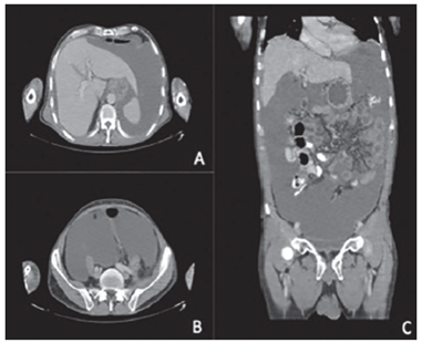 Tomograf&iacute;a computarizada prequir&uacute;rgica de abdomen y pelvis: A) corte axial del hemiabdomen superior; B) corte axial del hemiabdomen inferior, y C) corte coronal. En todos los cortes se aprecia gran cantidad de l&iacute;quido asc&iacute;tico y engrosamiento peritoneal.
