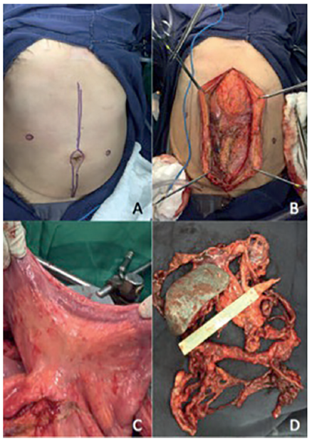 Aspectos t&eacute;cnicos del procedimiento quir&uacute;rgico. A) Planeaci&oacute;n de la incisi&oacute;n en la l&iacute;nea media con resecci&oacute;n de las cicatrices previas. B) Infiltraci&oacute;n generalizada de la cavidad por mesotelioma peritoneal. C) Compromiso del mesenterio del intestino delgado. D) Pieza quir&uacute;rgica tras la resecci&oacute;n del bazo y del peritoneo parietal de los cuatro cuadrantes del abdomen incluyendo c&uacute;pulas diafragm&aacute;ticas y pelvis.