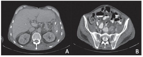 Tomograf&iacute;a computarizada posquir&uacute;rgica de abdomen con grandes cambios con respecto a la prequir&uacute;rgica. A) Corte axial del hemiabdomen superior. B) Corte axial del hemiabdomen inferior.