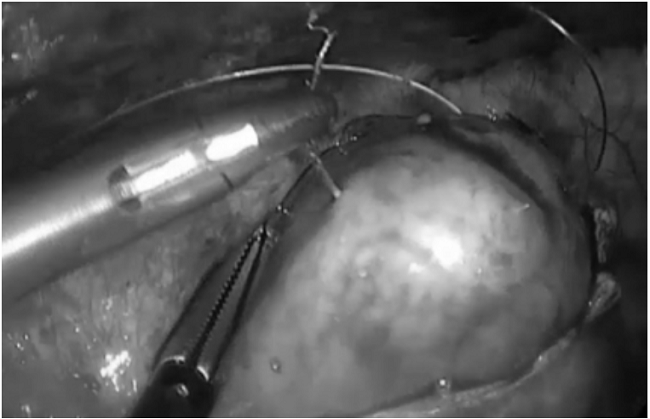 Reparo por toracoscopia de lesi&oacute;n de la cara anterior del ventr&iacute;culo derecho. La ventana pericardica por toracoscopia hab&iacute;a sido positiva y la lesi&oacute;n ventricular sangraba moderadamente (cortes&iacute;a doctores Correa J y Zuluaga M, Hospital Universitario del Valle).