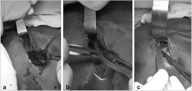 Manejo conservador de hemopericardio traum&aacute;tico, despu&eacute;s de ventana pericardica subxifoidea positiva. a. Evacuaci&oacute;n del contenido del saco peric&aacute;rdico, comprobando la ausencia de sangrado y la estabilidad hemodin&aacute;mica. b. Introducci&oacute;n de sonda al saco peric&aacute;rdico para realizar lavado. c. Aspiraci&oacute;n de l&iacute;quido cristalino al final del proceso de lavado. (cortes&iacute;a doctor Adolfo Gonz&aacute;lez, Hospital Universitario del Valle).