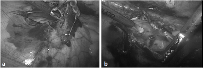 Manejo conservador de hemopericardio traum&aacute;tico, mediante toracoscopia. a. Ampliaci&oacute;n de la ventana practicada previamente, despu&eacute;s de comprobar la estabilidad y la ausencia de sangrado. b. Lavado de una herida superficial del ventr&iacute;culo derecho, comprobando la ausencia de sangrado. (Cortes&iacute;a, doctor Ala&iacute;n Herrera, Hospital Universitario del Valle).