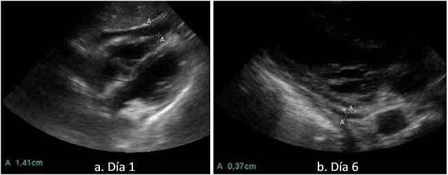 Seguimiento ecogr&aacute;fico de paciente estable hemodin&aacute;micamente. a. D&iacute;a primero. Derrame peric&aacute;rdico que en su m&aacute;xima dimensi&oacute;n mide 1.41 cent&iacute;metros. b. D&iacute;a sexto. Despu&eacute;s de disminuci&oacute;n progresiva, en el d&iacute;a sexto se encuentra una m&aacute;xima distancia del derrame de 0.37 cm.