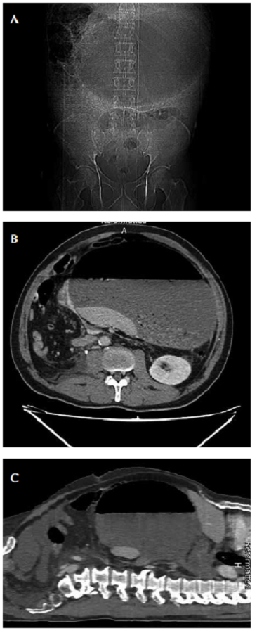 Paciente masculino, v&oacute;lvulo &oacute;rgano-axial. A. Radiograf&iacute;a de abdomen simple: gran dilataci&oacute;n de la c&aacute;mara g&aacute;strica; B. TC axial: distensi&oacute;n g&aacute;strica con nivel hidroa&eacute;reo; C. TC en plano sagital: est&oacute;mago de localizaci&oacute;n central, distendido y con nivel hidroa&eacute;reo.