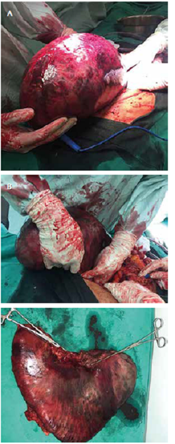 A. V&oacute;lvulo agudo con isquemia y necrosis. B. Reducci&oacute;n manual. C. Gastrectom&iacute;a total: est&oacute;mago sin v&oacute;lvulo con cambios isqu&eacute;micos y necr&oacute;ticos.