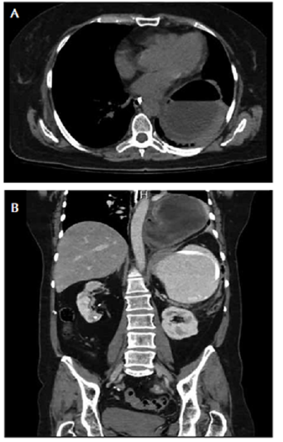A. TC axial: hemit&oacute;rax izquierdo ocupado por parte del est&oacute;mago, el cual se encuentra dilatado y contiene un nivel hidroa&eacute;reo. B. Hernia hiatal de tipo III: est&oacute;mago en &lsquo;reloj de arena&rsquo;, herniado y con v&oacute;lvulo, que ocupa la base del hemit&oacute;rax izquierdo.