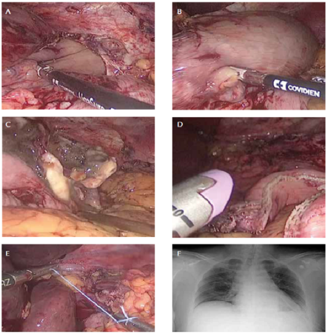 A. Reducci&oacute;n de la hernia hiatal. B. Reducci&oacute;n del v&oacute;lvulo g&aacute;strico. C. Perforaci&oacute;n del cuerpo g&aacute;strico por necrosis secundaria al v&oacute;lvulo. D. Gastrectom&iacute;a vertical con suturas mec&aacute;nicas con correcci&oacute;n de la perforaci&oacute;n, secundaria a la necrosis. E. Correcci&oacute;n de la hernia hiatal. F. Receso costo-diafragm&aacute;tico izquierdo borrado y tubo de t&oacute;rax en la base izquierda.