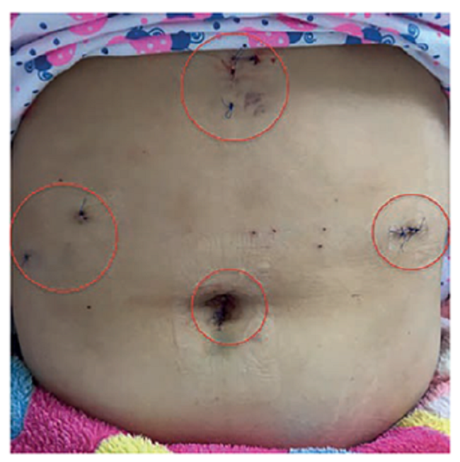 Puertos quir&uacute;rgicos en la paciente del caso 2.