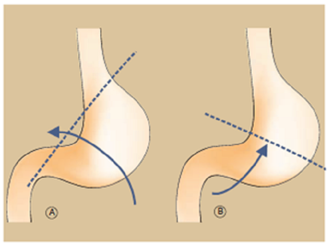 A. V&oacute;lvulo &oacute;rgano-axial por rotaci&oacute;n del est&oacute;mago sobre su eje longitudinal. B. V&oacute;lvulo mesent&eacute;rico-axial por rotaci&oacute;n del est&oacute;mago sobre su eje transverso.