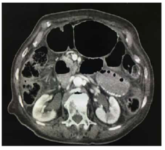 TC abdominal con contraste: importante distensión de asas intestinales sin divertículos evidentes a este nivel.