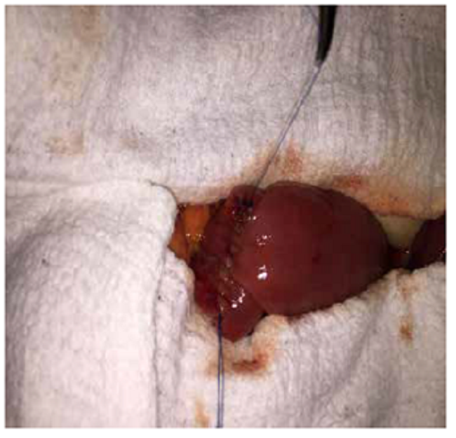 Sutura de refuerzo posterior a la resección y la anastomosis.