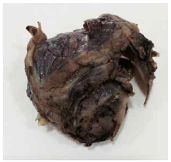 Pieza quir&uacute;rgica extra&iacute;da en la laparotom&iacute;a exploratoria.