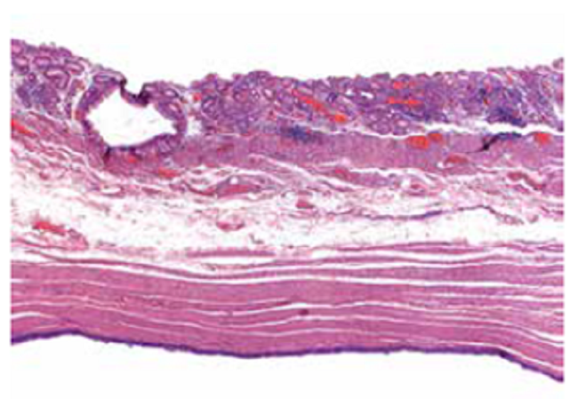 Superficie de la mucosa g&aacute;strica y epitelio ciliado del quiste en el lado opuesto. Hematoxilina y eosina, 20X.