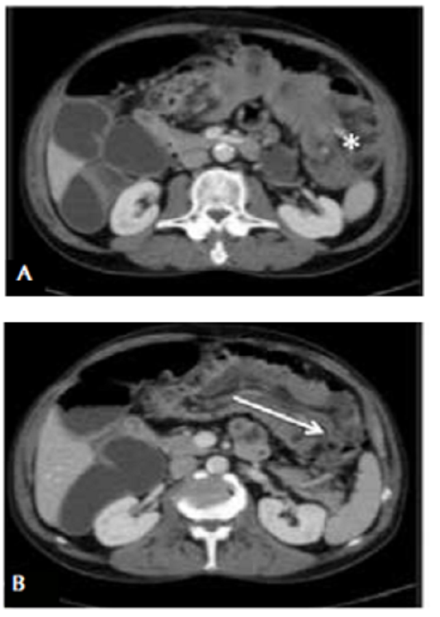 TC abdominal, corte axial. A. Masa sobre el colon transverso (asterisco). B. Origen de la intususcepción (flecha) en el colon transverso y extensión hacia el colon descendente.