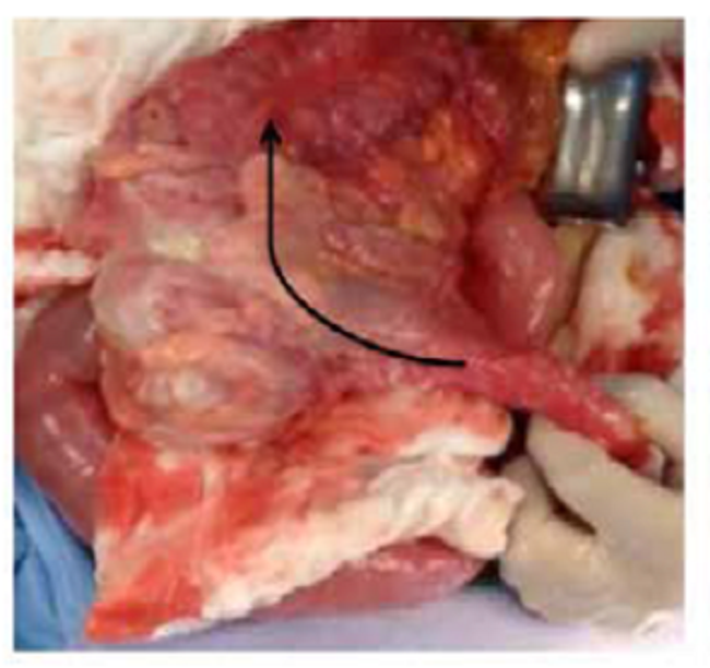 Pieza quirúrgica: intususcepción colocólica en el colon transverso derecho hacia el colon descendente (flecha).