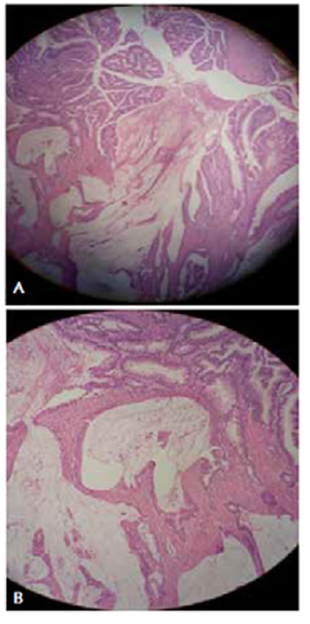 A y B. Adenocarcinoma moderadamente diferenciado con componente mucinoso. Hematoxilina y eosina, 200X.