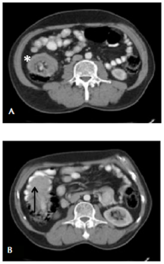 TC abdominal, corte axial. A. Intususcepción ileocólica con signo de la diana (asterisco). B. Origen de la intususcepción (flecha) en la válvula ileocecal y extensión de la lesión.