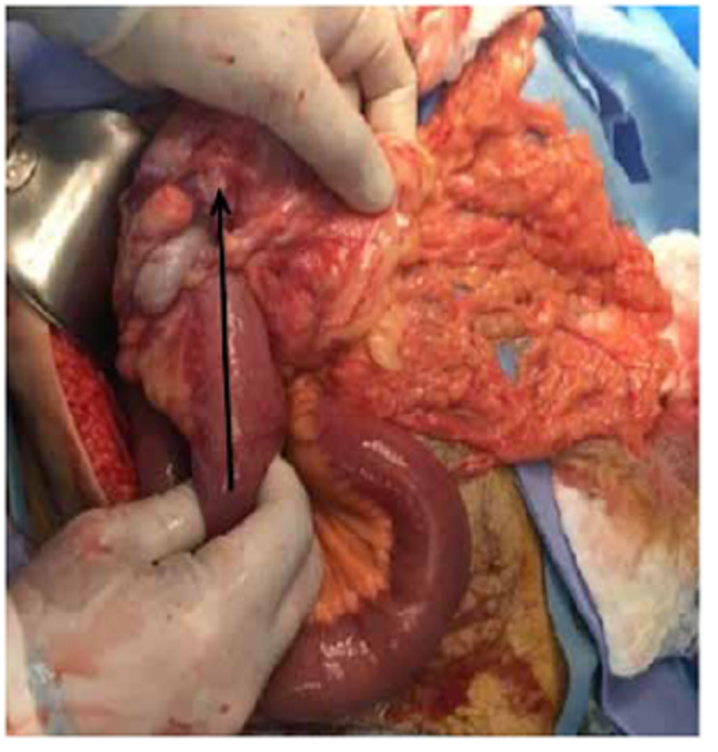 Pieza quirúrgica: intususcepción ileocólica (flecha) e intestino dilatado proximalmente.