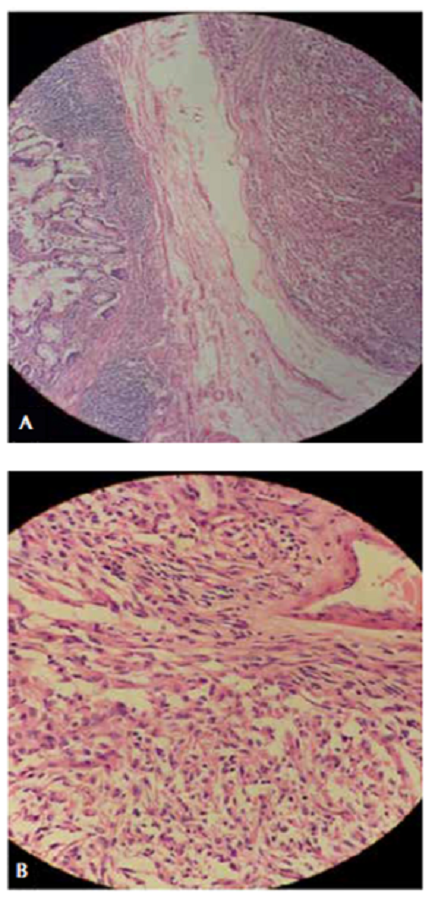 A. Tumor del estroma gastrointestinal (GIST). Hematoxilina y eosina, 200X B. Células tumorales en forma de huso. Hematoxilina y eosina, 40X.