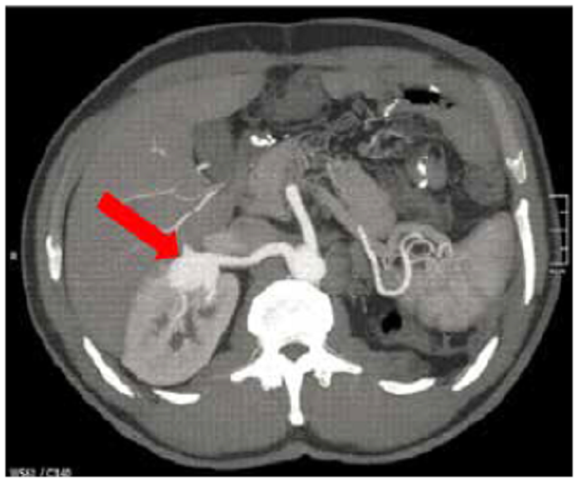 Tomograf&iacute;a computadorizada abdominal, corte axial: se observa aneurisma de arteria renal derecha a nivel del hilio renal e hipoplasia renal izquierda.