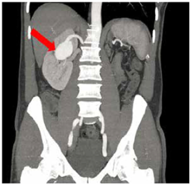 Tomograf&iacute;a computadorizada abdominal, corte coronal: se observa aneurisma de arteria renal derecha a nivel del hilio renal e hipoplasia renal izquierda.