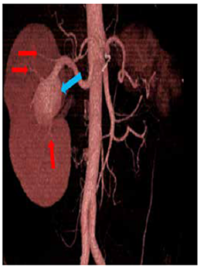 Arteriograf&iacute;a renal; flecha azul, aneurisma de arteria renal derecha en su segmento hiliar; flechas rojas, ramas arteriales saliendo del aneurisma.