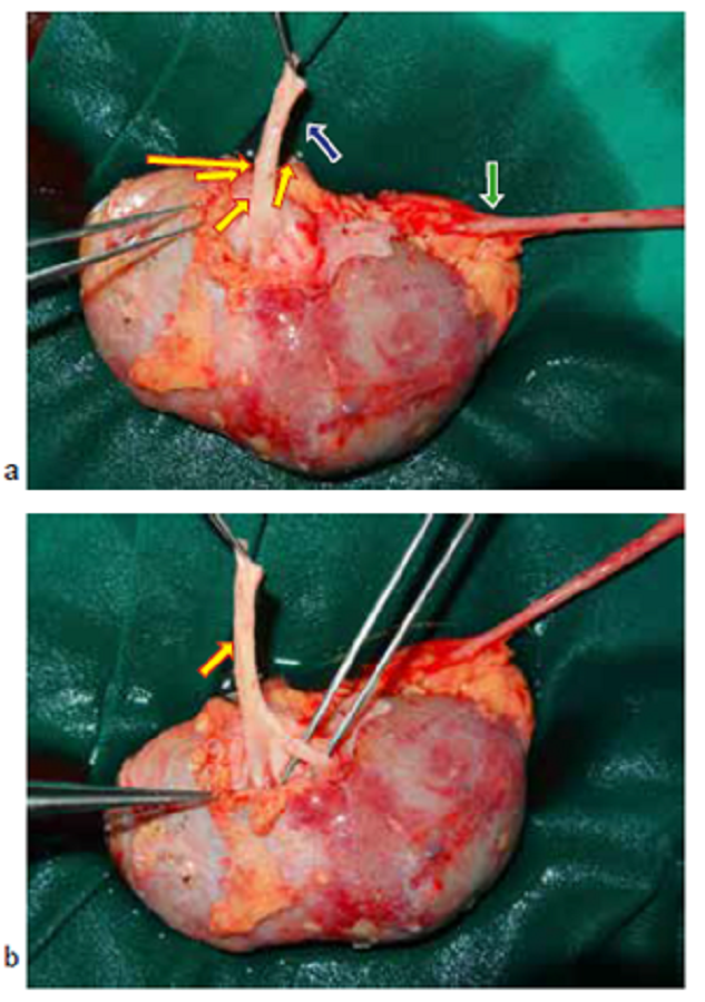 a y b. Flechas amarillas: arteria renal derecha aneurism&aacute;tica y sus ramas; flecha azul: vena renal derecha; flecha verde: ur&eacute;ter derecho.