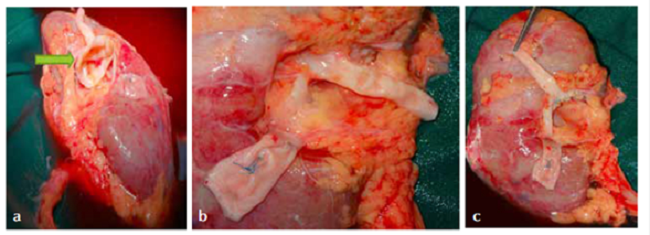 A. Se observa aneurisma &lsquo;marsupializado&rsquo; se&ntilde;alado con flecha verde; B. arteria renal derecha reconstruida en su cara anterior; c. arteria renal derecha reconstruida en su cara posterior