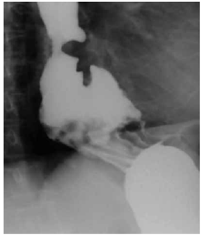 Esofagograma con bario: dilataci&oacute;n leve del es&oacute;fago medio y distal, secundaria a estenosis esof&aacute;gica y hernia hiatal.