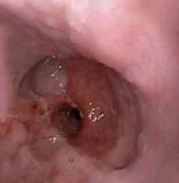 Endoscopia de v&iacute;as digestivas altas: fibrosis esof&aacute;gica con importante estenosis secundaria, que pudo dilatarse con bal&oacute;n esof&aacute;gico.