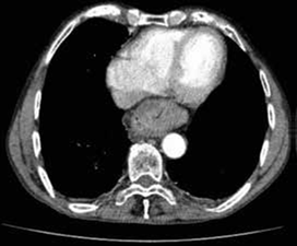 Tomograf&iacute;a computarizada: est&oacute;mago localizado en el mediastino posterior.