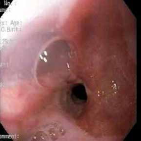 Endoscopia de v&iacute;as digestivas altas: estenosis esof&aacute;gica con una luz de 10 mm de di&aacute;metro, aproximadamente.