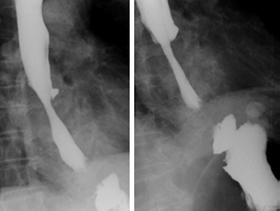 Esofagograma posoperatorio: es&oacute;fago proximal tortuoso y ensanchado, con paso filiforme de medio de contraste en la fundoplicatura y est&oacute;mago descendido en el abdomen.