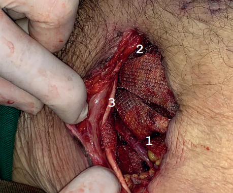 Malla en el espacio preperitoneal: 1. Elementos del cord&oacute;n a trav&eacute;s de la malla por el nuevo anillo. 2. M&uacute;sculo recto abdominal. 3. Aponeurosis del m&uacute;sculo oblicuo mayor.