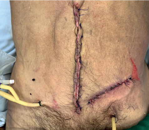 Drenaje posoperatorio despu&eacute;s del cierre de la pared abdominal y herniorrafia inguinal con malla en una herida sucia por perforaci&oacute;n asociada a peritonitis fecal.