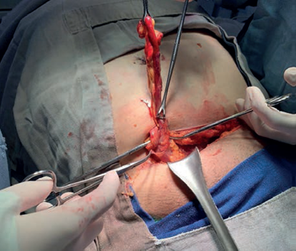 Hernia de Garengeot, apendicitis aguda fibrinopurulenta en hernia crural encarcelada.