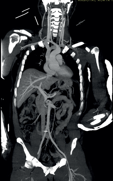 Reconstrucción coronal de TC corporal total. Se puede observar la aorta (flecha blanca) y la vena porta (flecha gris), y, además, desde las estructuras vasculares del cuello (arterias carótidas y venas yugulares), del corazón, del hígado (arterias suprahepáticas), hasta las ilíacas (arterias y venas). Se observa la estructura de los diferentes órganos sólidos y huecos, y las estructuras óseas, para evaluar posibles lesiones (en este caso, fractura del radio izquierdo), sin interferencia por el yeso usado para la inmovilización.