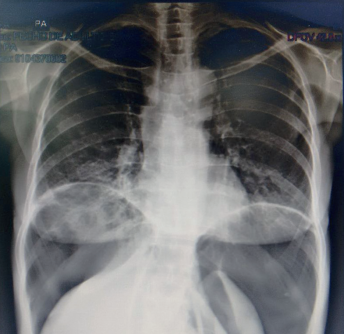 Radiograf&iacute;a de t&oacute;rax en la que se observa imagen de neumoperitoneo.