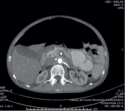 Tomograf&iacute;a computarizada de abdomen simple y con contraste, en las que se observa neumoperitoneo y l&iacute;quido libre en la cavidad peritoneal.