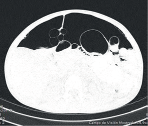 Tomograf&iacute;a computarizada, ventana pulmonar, donde se observa c&aacute;mara de neumoperitoneo, adem&aacute;s de gas que se distribuye en forma de burbujas en la pared del intestino delgado y en el ligamento falciforme del h&iacute;gado.