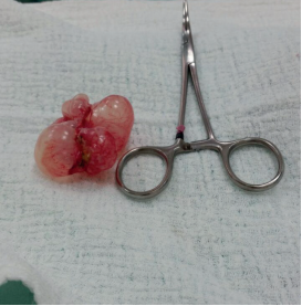 Quistes neum&aacute;ticos adheridos al ligamento falciforme del h&iacute;gado.