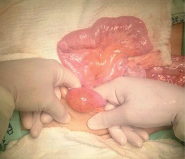 Quistes neum&aacute;ticos en algunas asas intestinales delgadas.