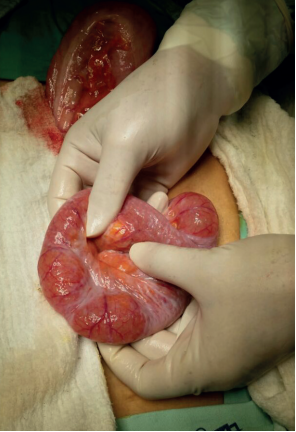 Zonas ovoides de serosa despulida en las asas intestinales, que sugieren ruptura espont&aacute;nea de los quistes neum&aacute;ticos intestinales.