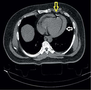Chest CT scan. White arrow shows hemopericardium; Yellow arrow shows a small pneumopericardium.