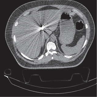 Scan of abdomen revealed the bullet on Couinaud’s segment IV of the liver.