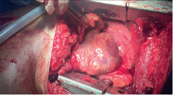 No damage to the heart.