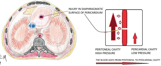 Cavities with different pressure levels in contact.