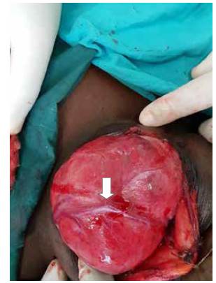 Vista del sitio operatorio. Obs&eacute;rvese la amplia vascularizaci&oacute;n de la gl&aacute;ndula (flecha blanca).