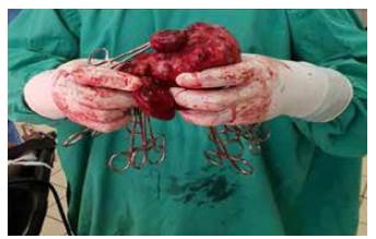 Se muestra la pieza de ex&eacute;resis quir&uacute;rgica.